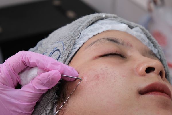 Acne Scar Treatment