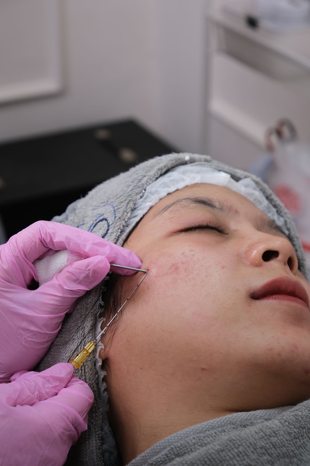 What Is Microneedling? Benefits, Results & Downtime What Is Microneedling? Benefits, Results & Downtime