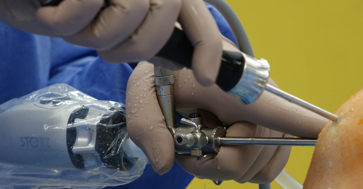 Detailed view of a surgeon performing arthroscopic knee surgery using specialized equipment. - Evidence evidence guide for glucosamine knee osteoarthritis meta-analysis