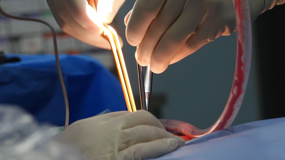 surgical incision lines for a belt lipectomy surgical incision lines for a belt lipectomy