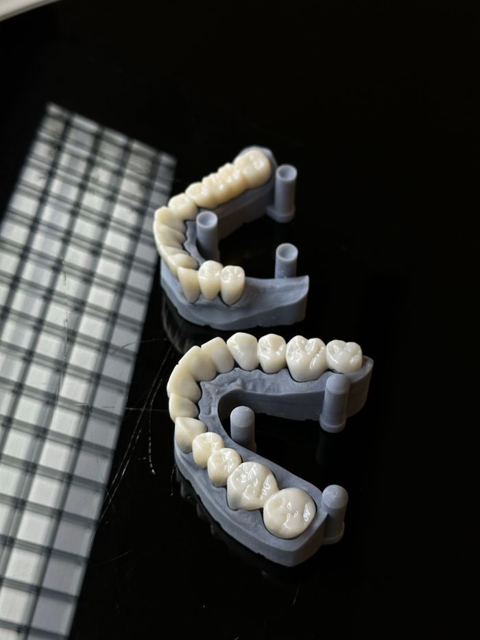 Zirconia vs E.max: choosing well