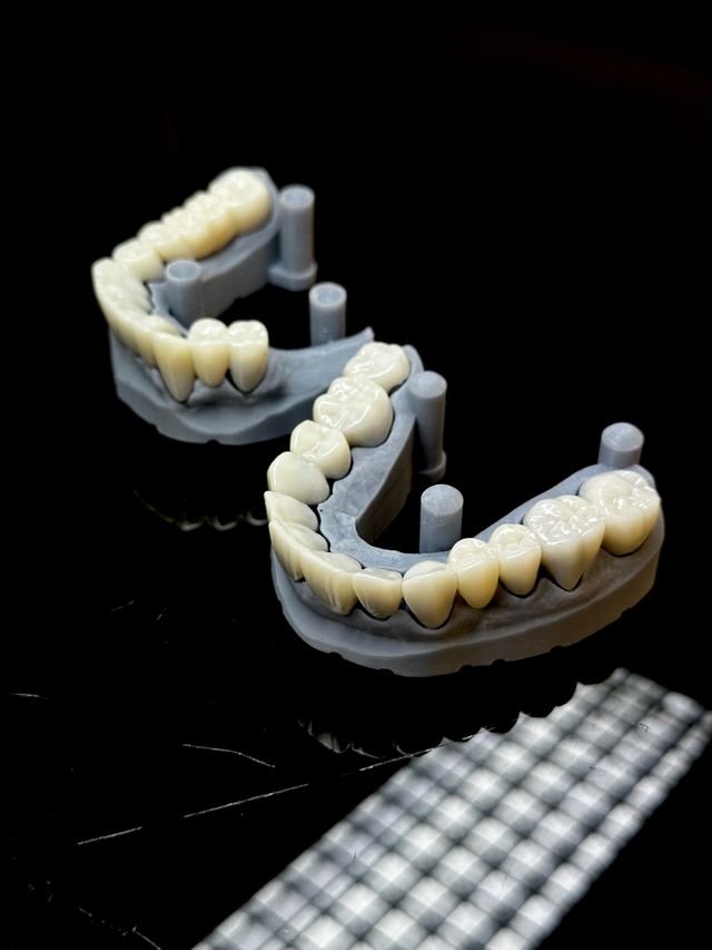 Invisalign Refinements Explained: Why You Might Need a Second Set