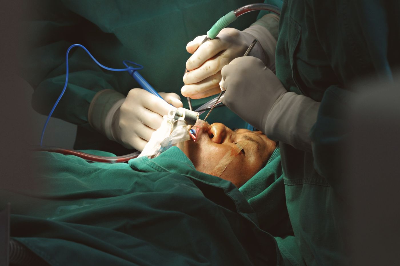 Equipo quirúrgico realizando una cirugía facial reconstructiva en un entorno estéril
