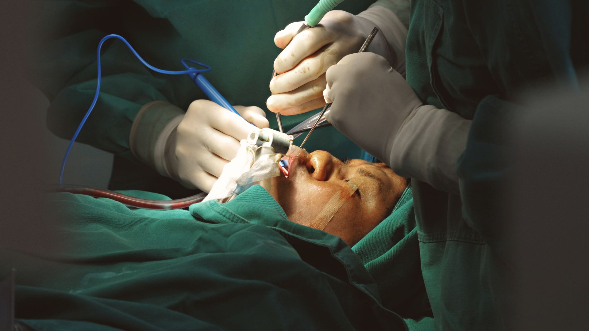 Modafinil for Surgeons: Exploring the Benefits of Smart Drugs 4 Surgeons in sterile environment performing delicate facial surgery with precision instruments — modafinil for surgeons