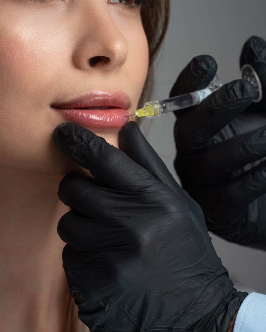 Doctor treating the corner of the mouth for a non-surgical mouth corner lift at Bailor Clinic in Sinsa, Gangnam