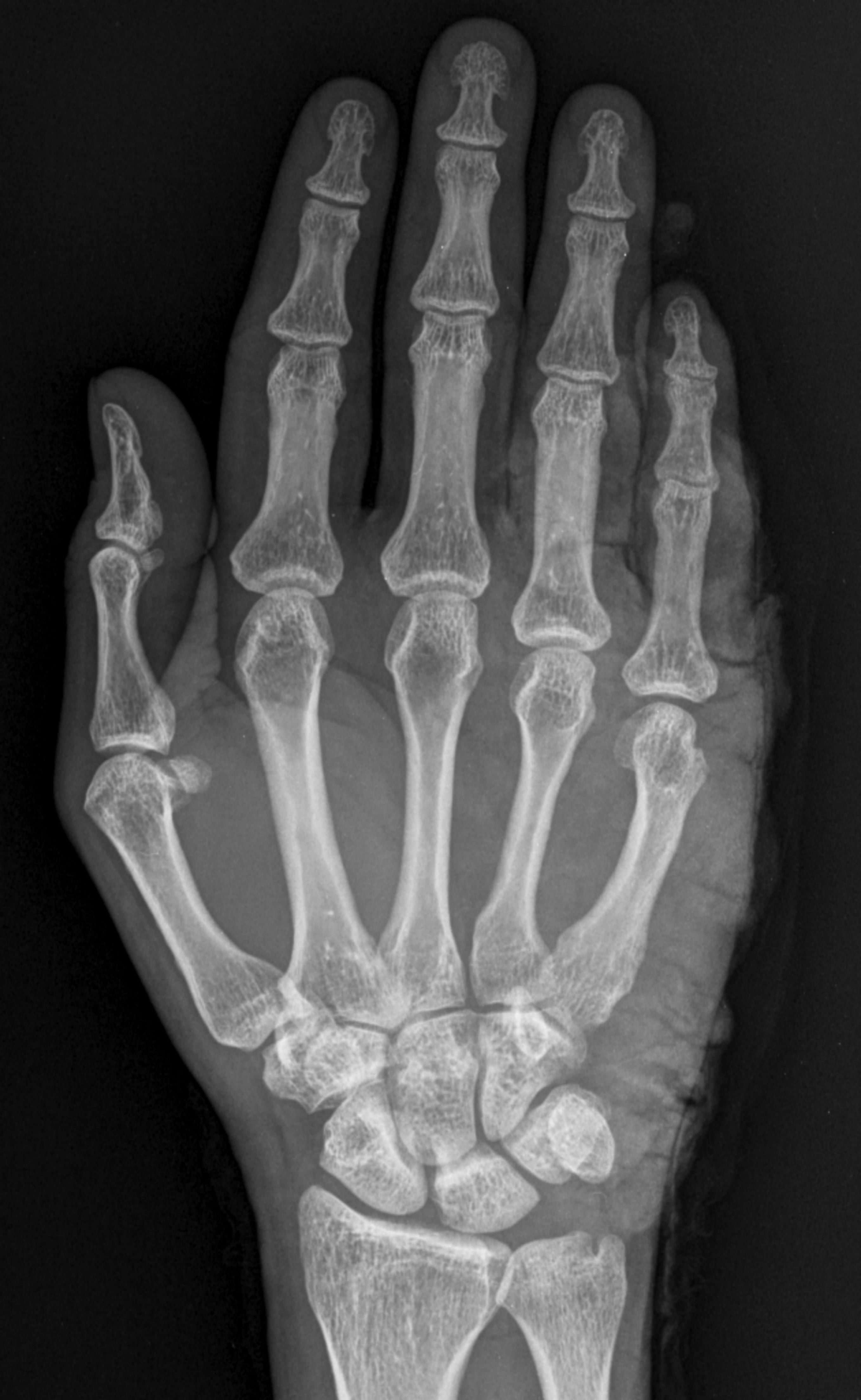M05.9: Seropositive Rheumatoid Arthritis, Unspecified - Panduan Lengkap