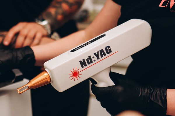 Tattoo Removal