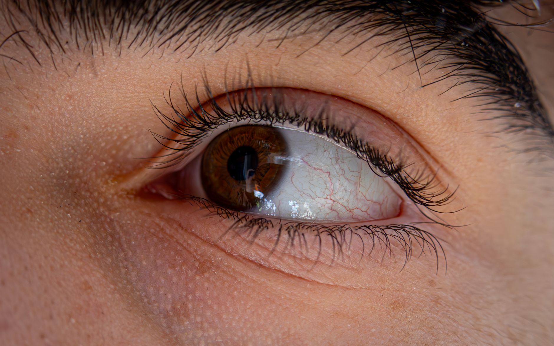 Veiny Eyelids: Understanding the Causes and Treatment Options