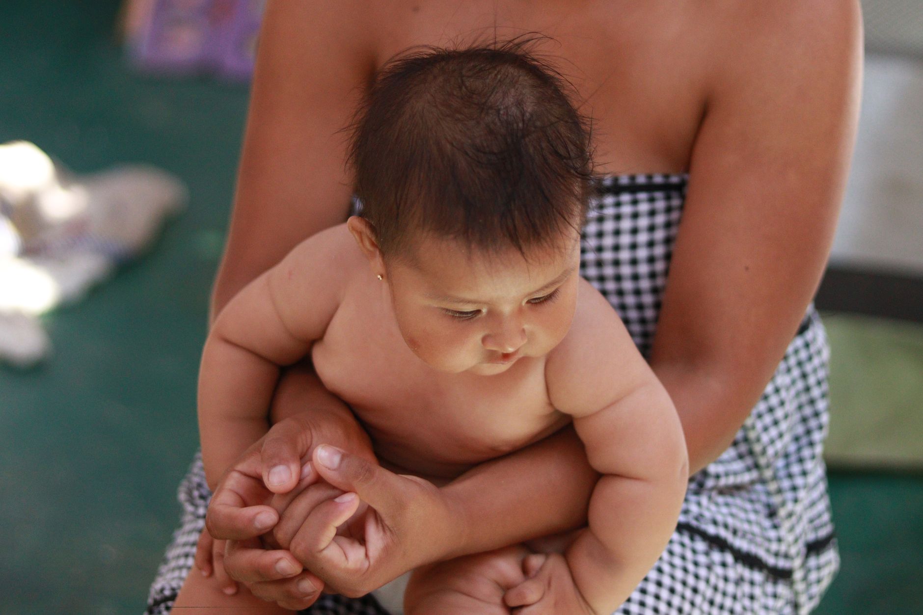 Congenital Nevus: Understanding Birthmarks from Birth