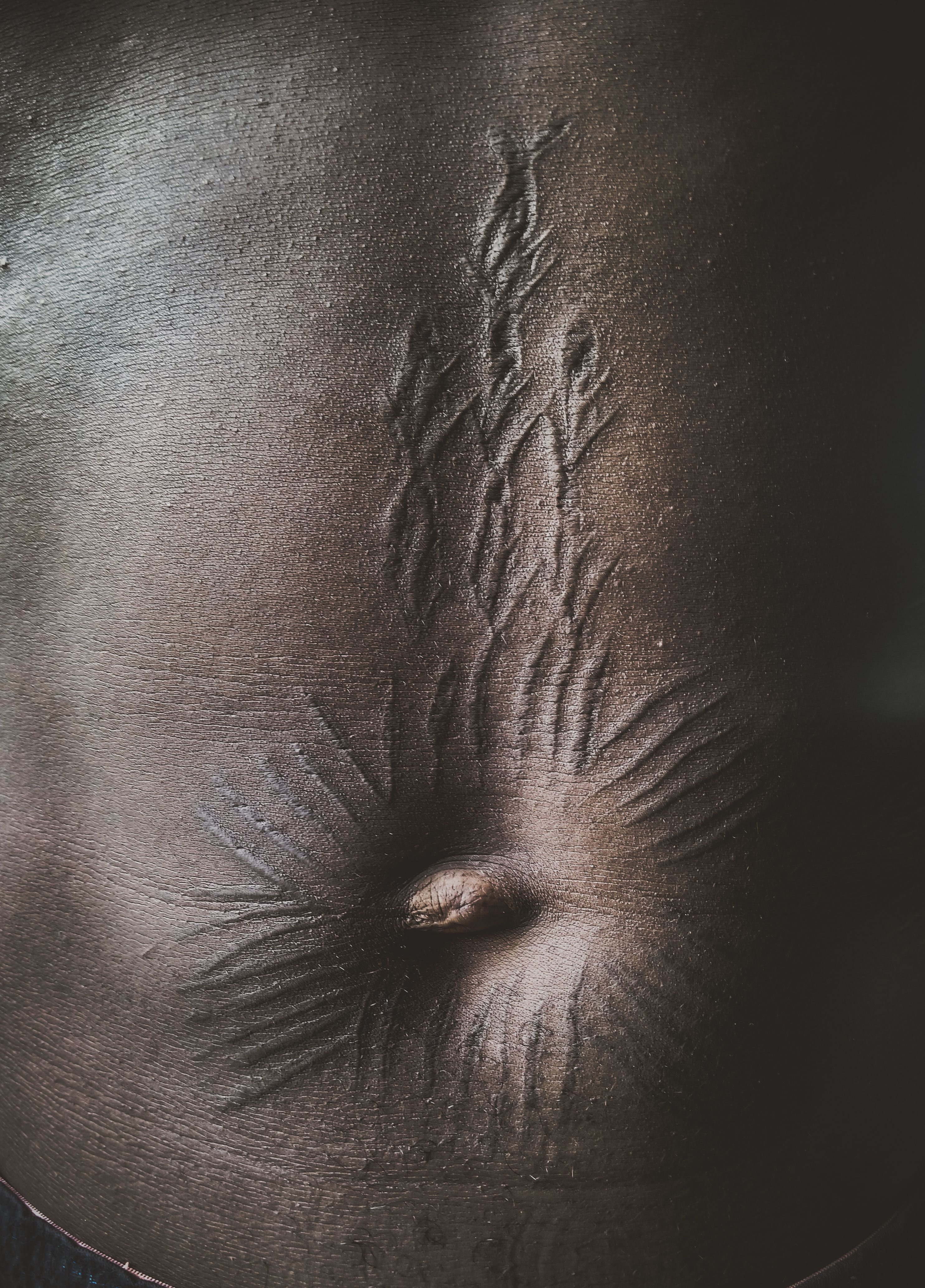 40 Ways To Get Rid Of Stretch Marks