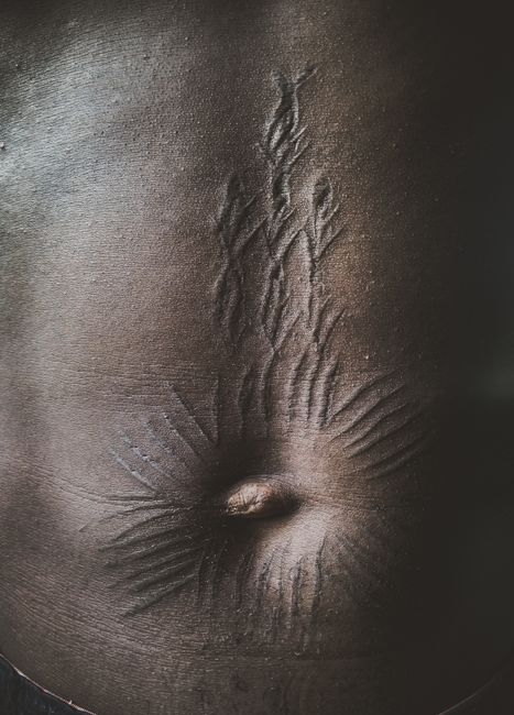 수족구 초기 증상 지나간 자리, 색소 침착과 흉터 관리하는 방법 0