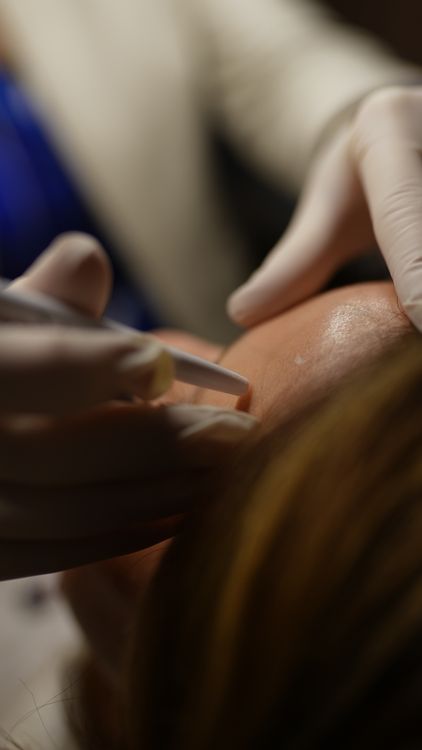 Dermaplaning facial treatment at Tu Bella Beauty Salon Hemel Hempstead