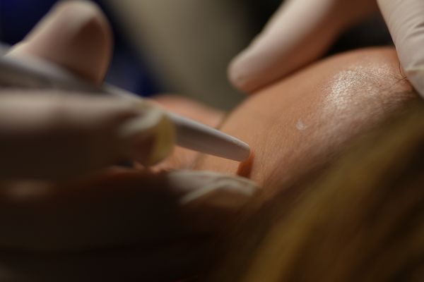 Microneedling