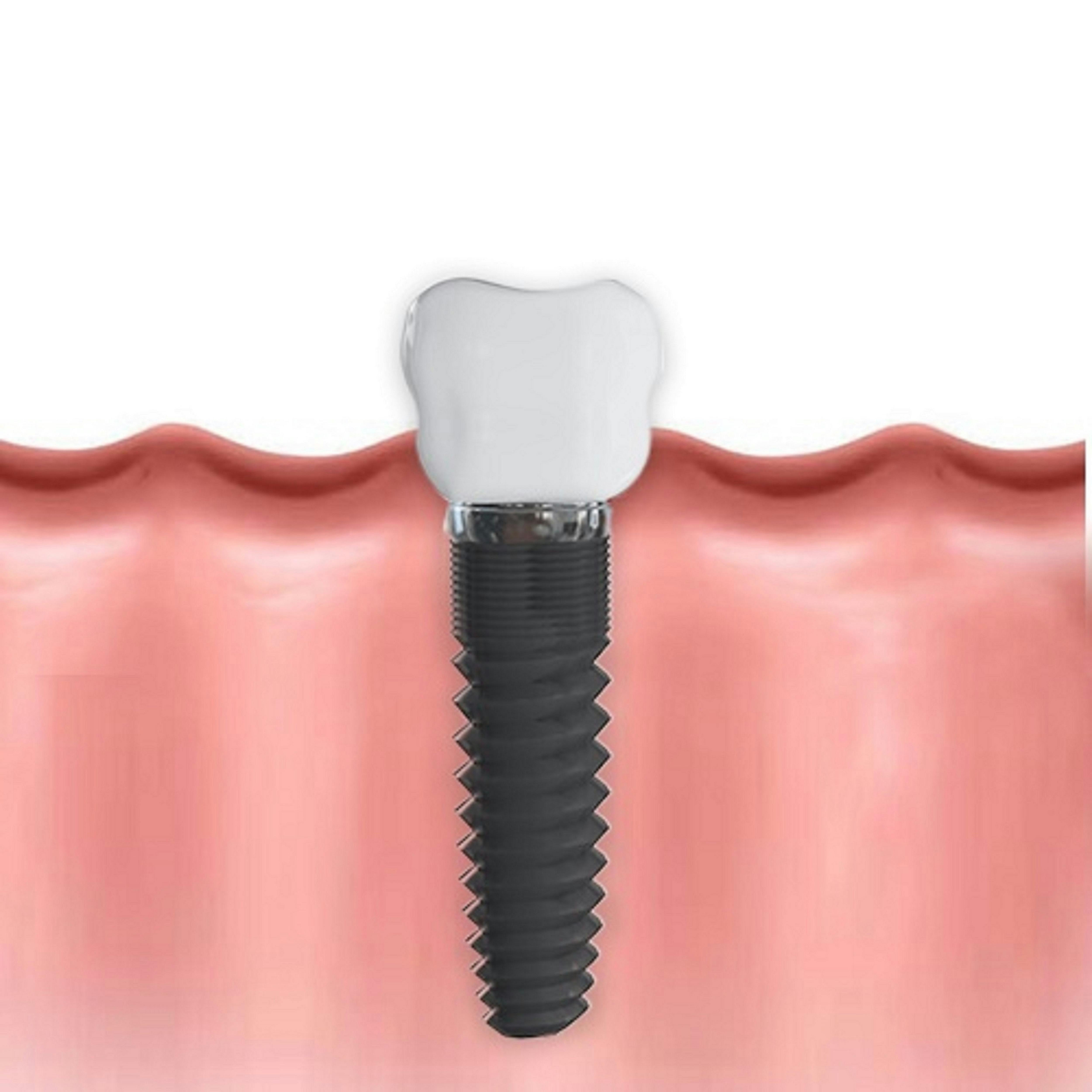 Free stock photo of dental, dental implants, dentist