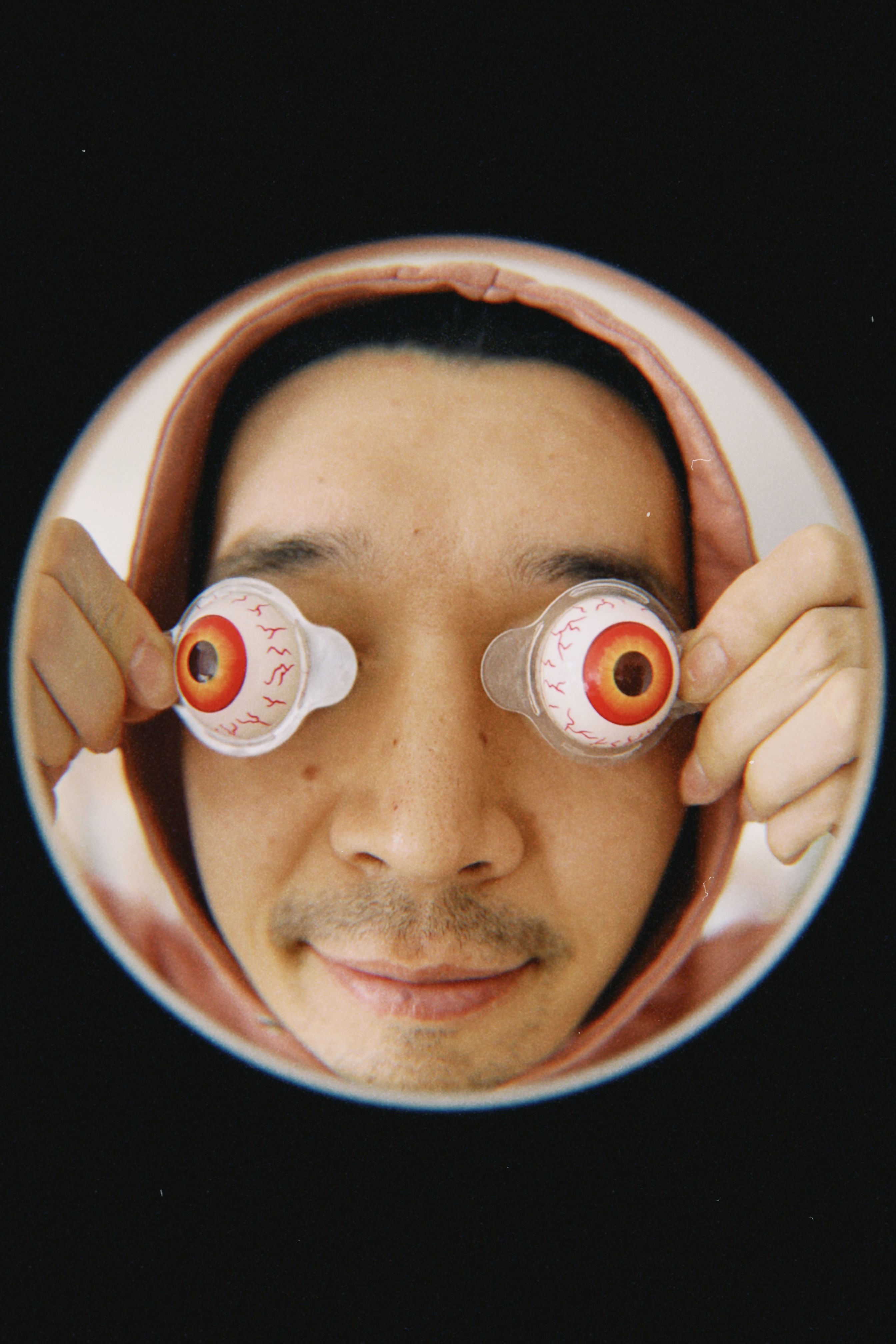 Q11.0: Cystic Eyeball - Kista Bola Mata Kongenital