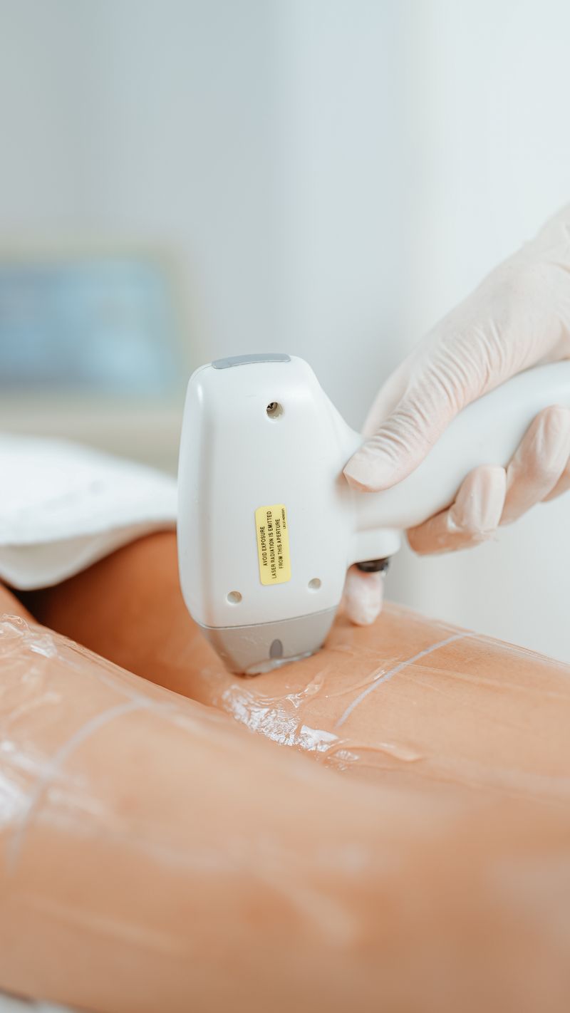 Laser hair removal treatment