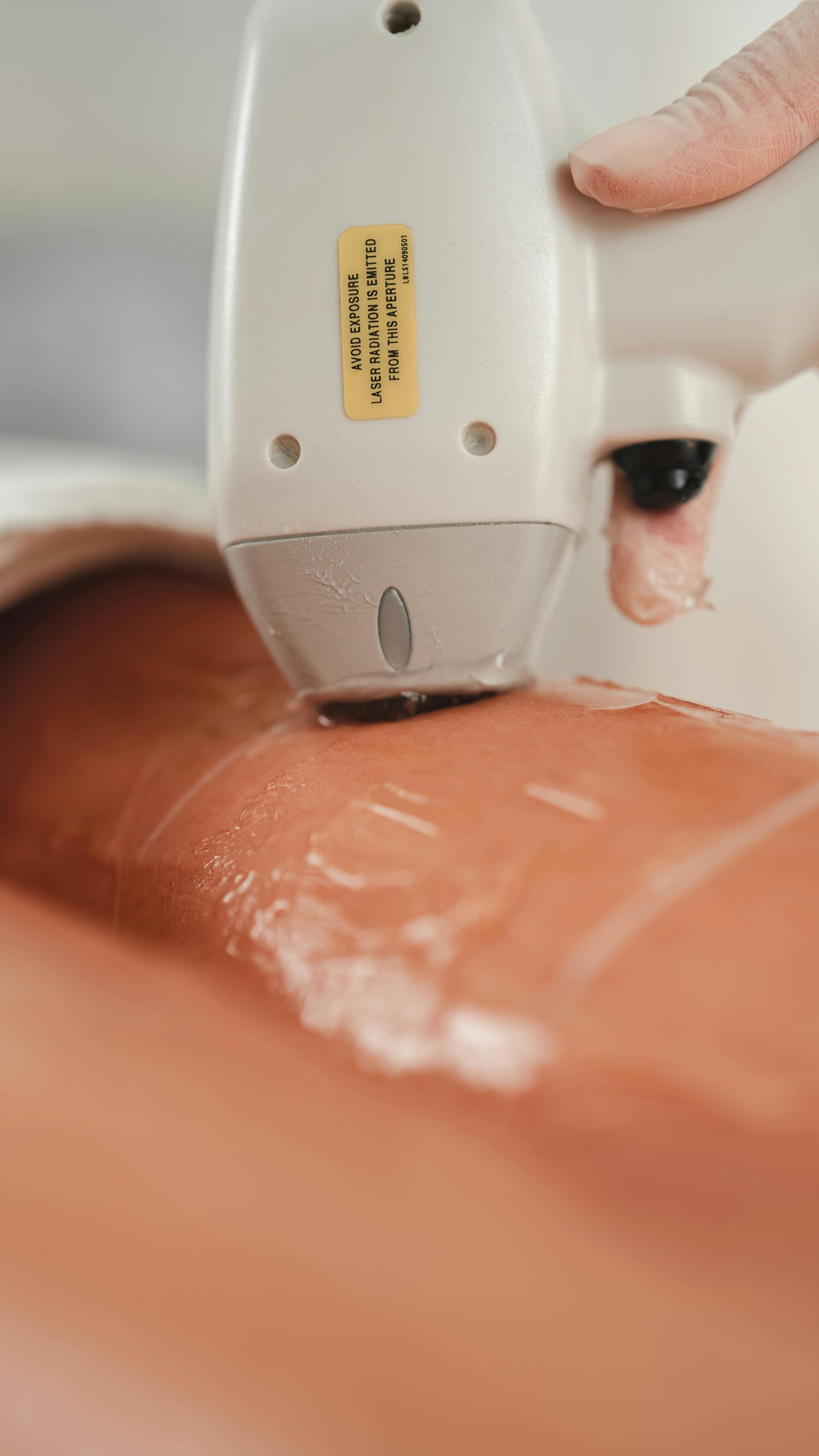 Close-up shot of a laser hair removal procedure being performed on skin with cooling gel application.