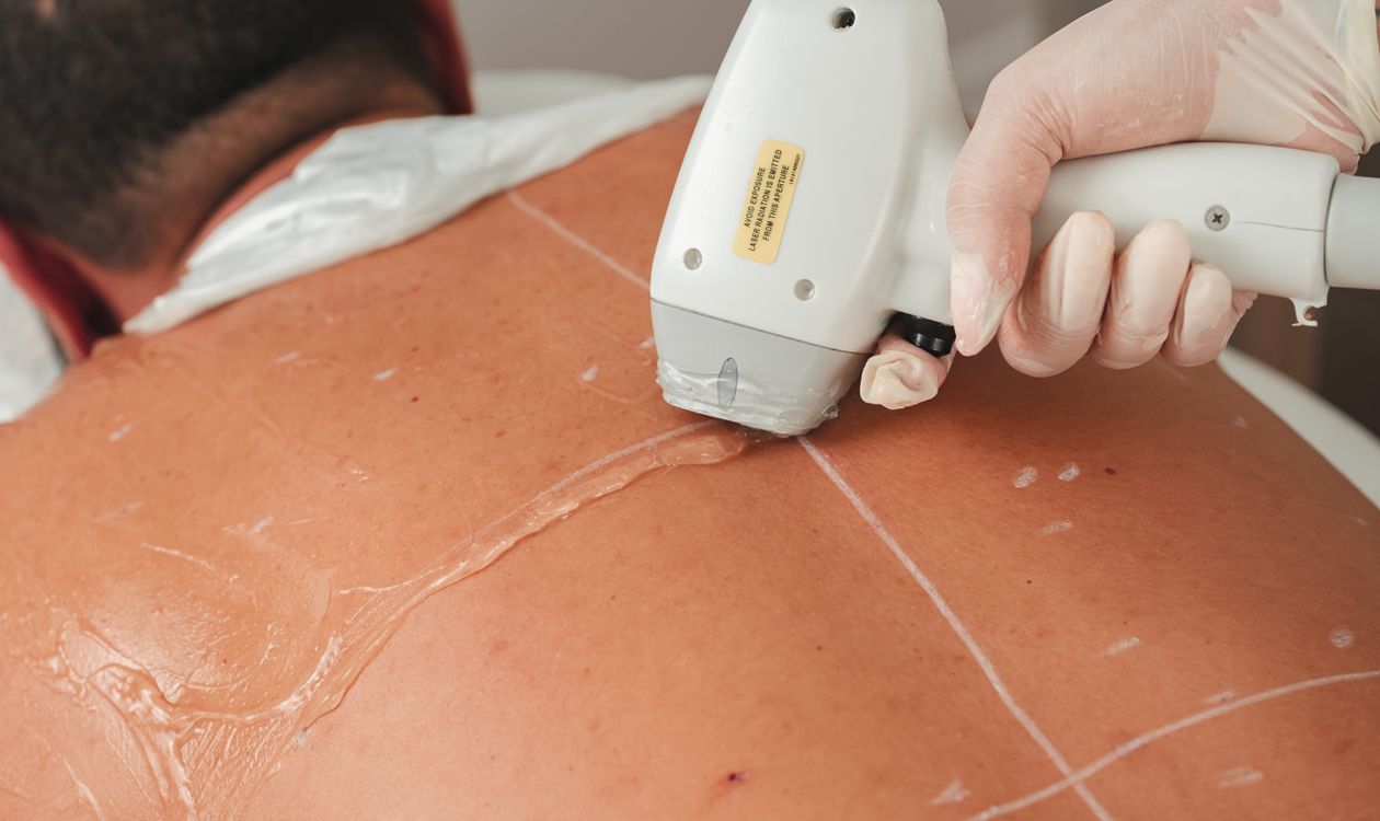 Depilación láser masculina en espalda con cabezal de diodo, Sapphira Privé Montecarmelo