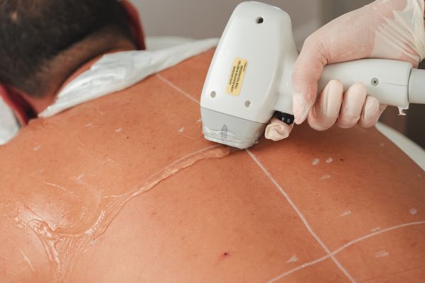 Laser treatment tại spa chuyên nghiệp
