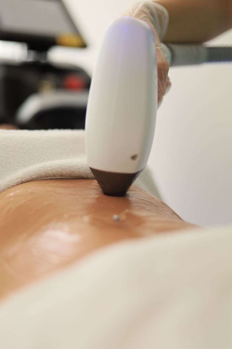 Laser Hair Removal – Small Area at Poetry MedSpa