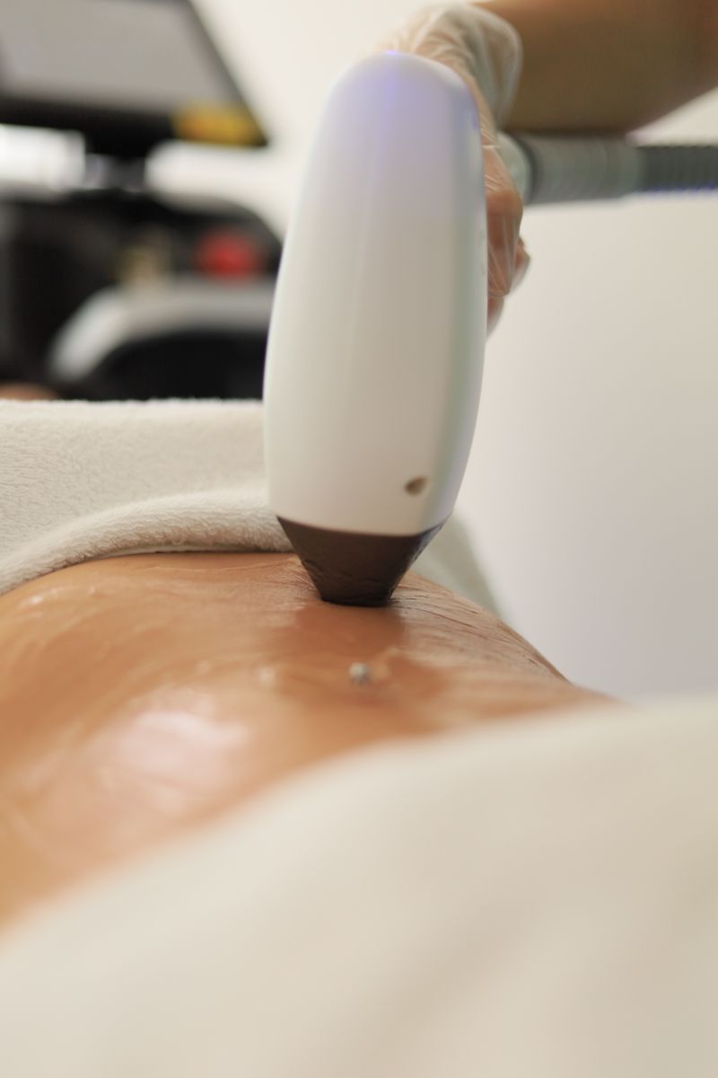 Laser Pigmentation Removal