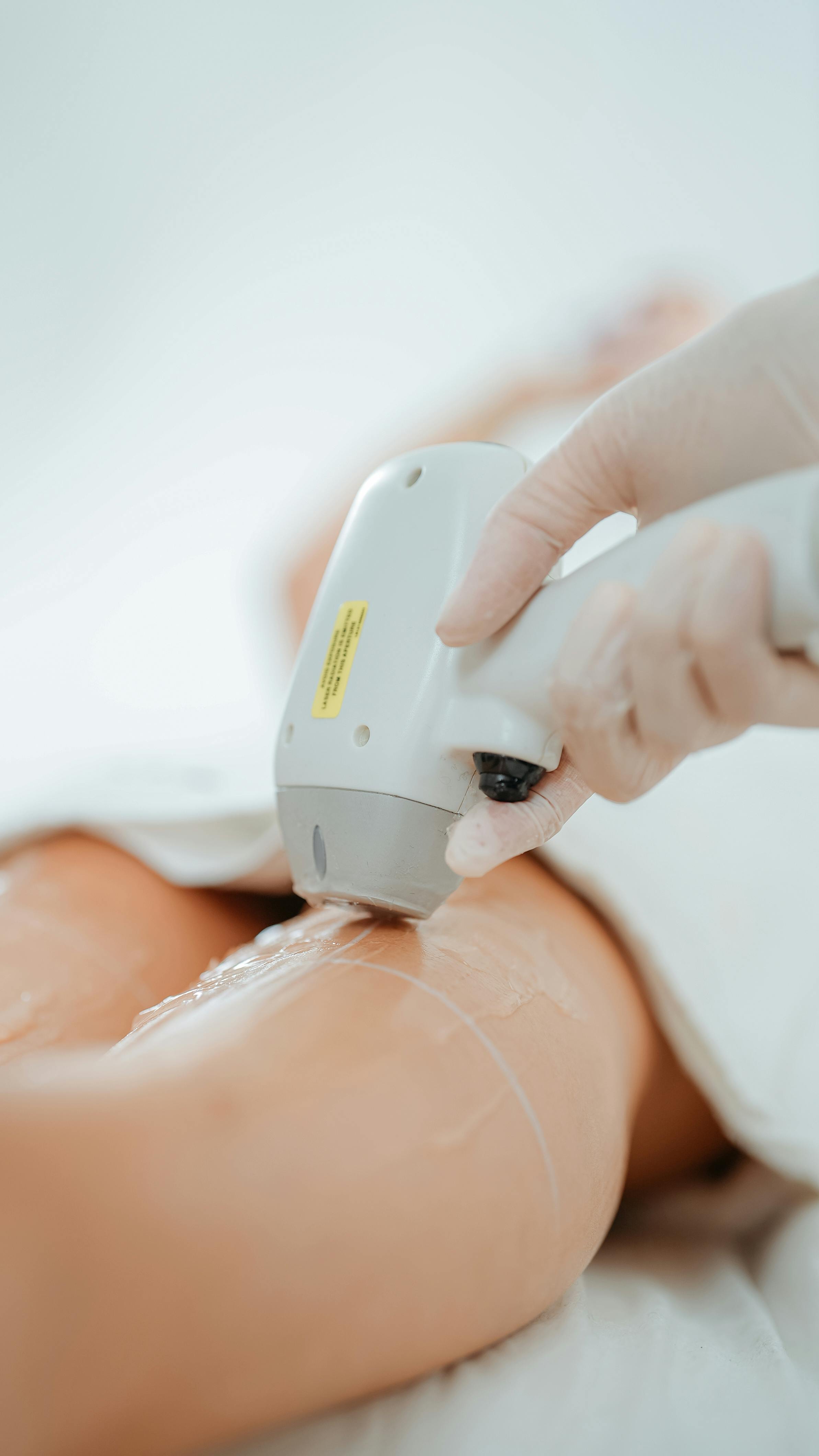 Close-up of a laser epilation procedure in a clinical setting for smooth skin results.