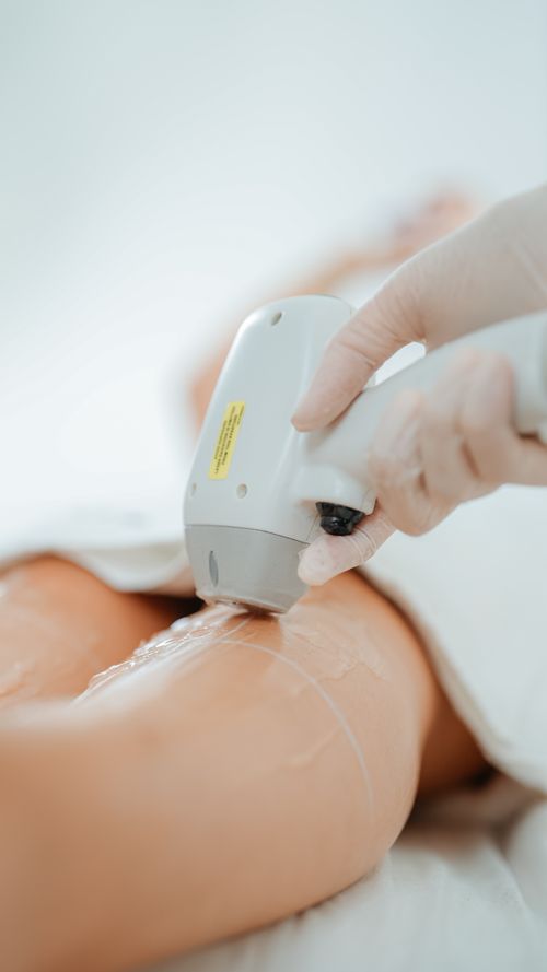 Laser epilation procedure
