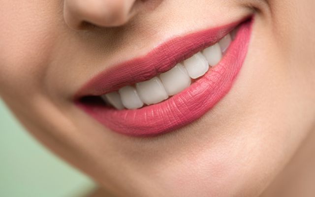 لمینت سرامیکی