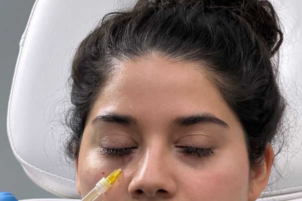 Tear Trough Fillers
