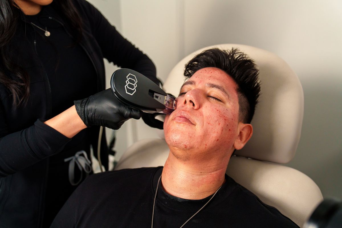 Morpheus8 radiofrequency skin treatment being performed at a modern med spa.