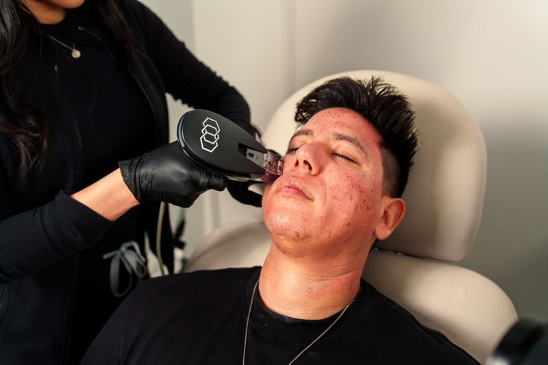 Morpheus8 RF microneedling treatment