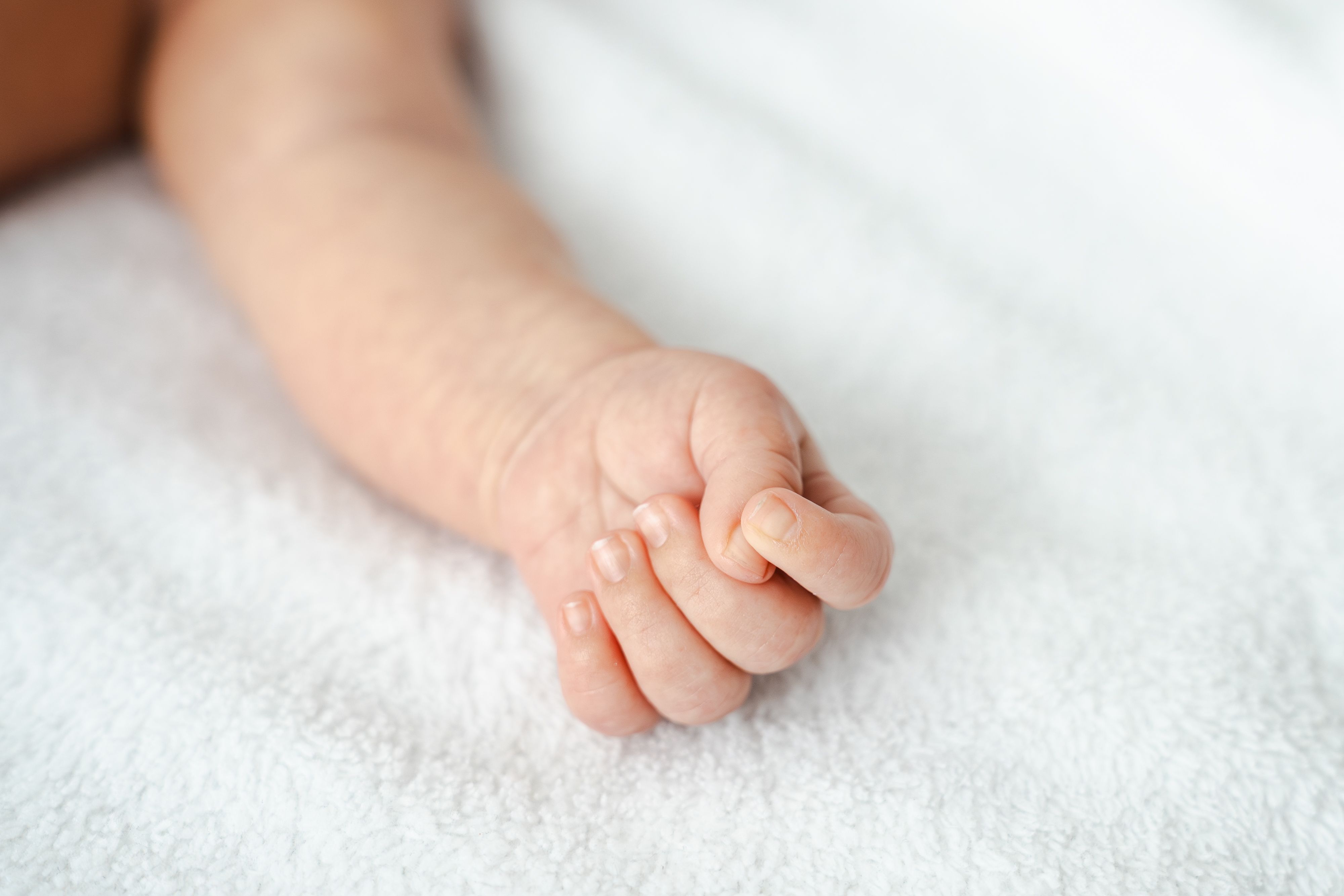 Q71.3: Absence Kongenital Tangan dan Jari (Congenital Absence of Hand and Finger(s))