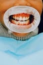 Person with Dental Cheek Retractor