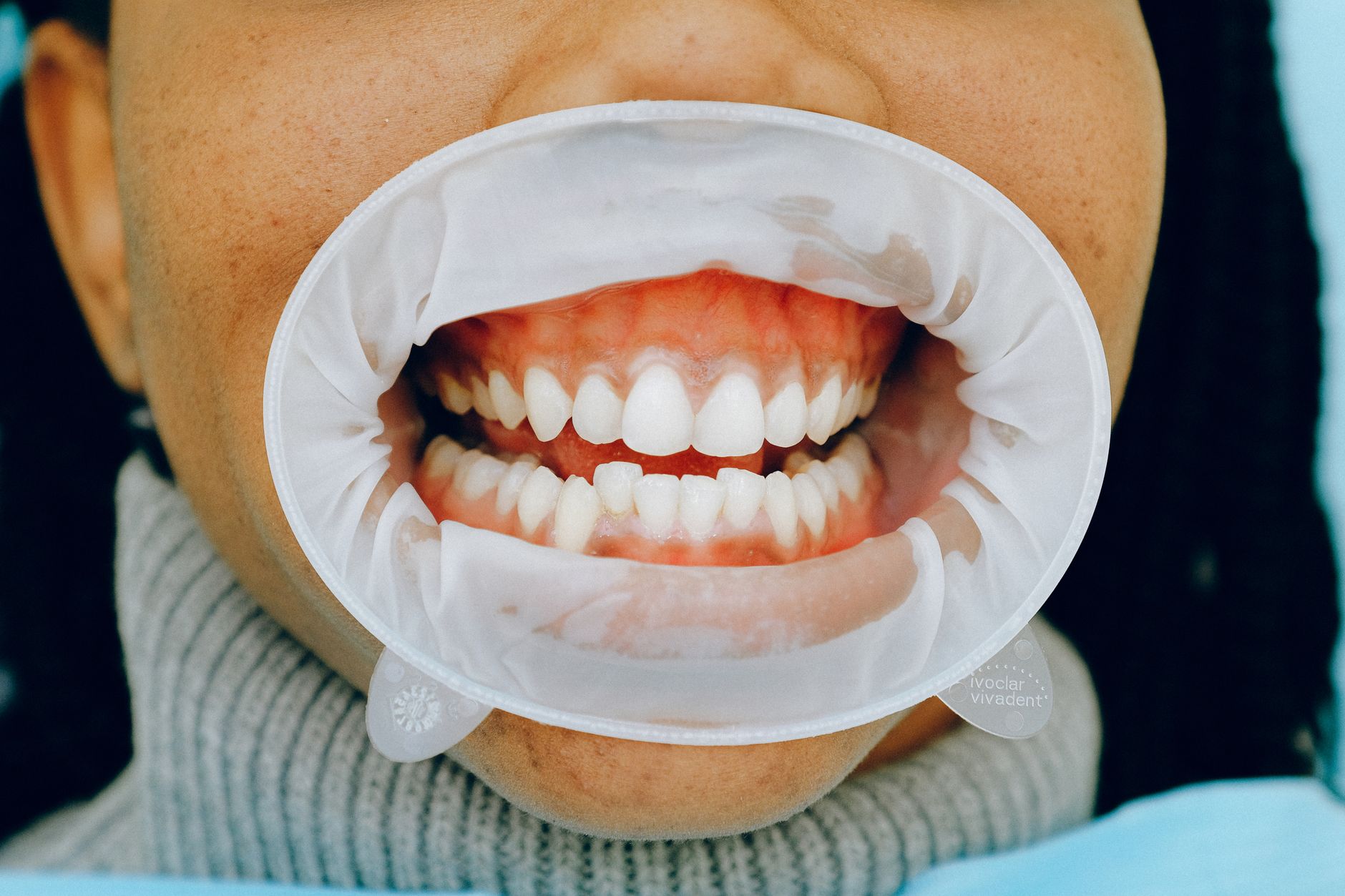 Alternatives Dental Clips for Missing Teeth