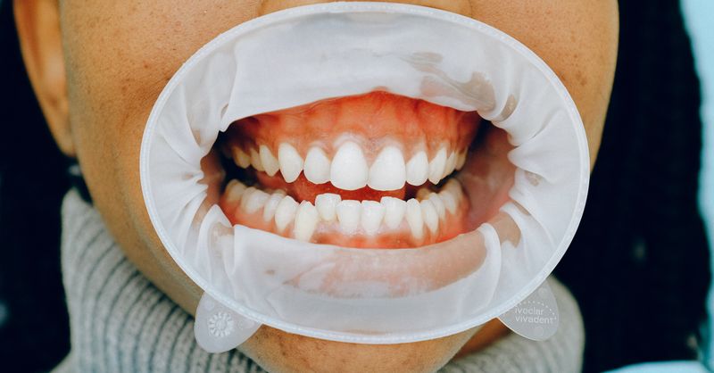 Joue gonflée par abcès dentaire : durée, évolution et solutions rapides