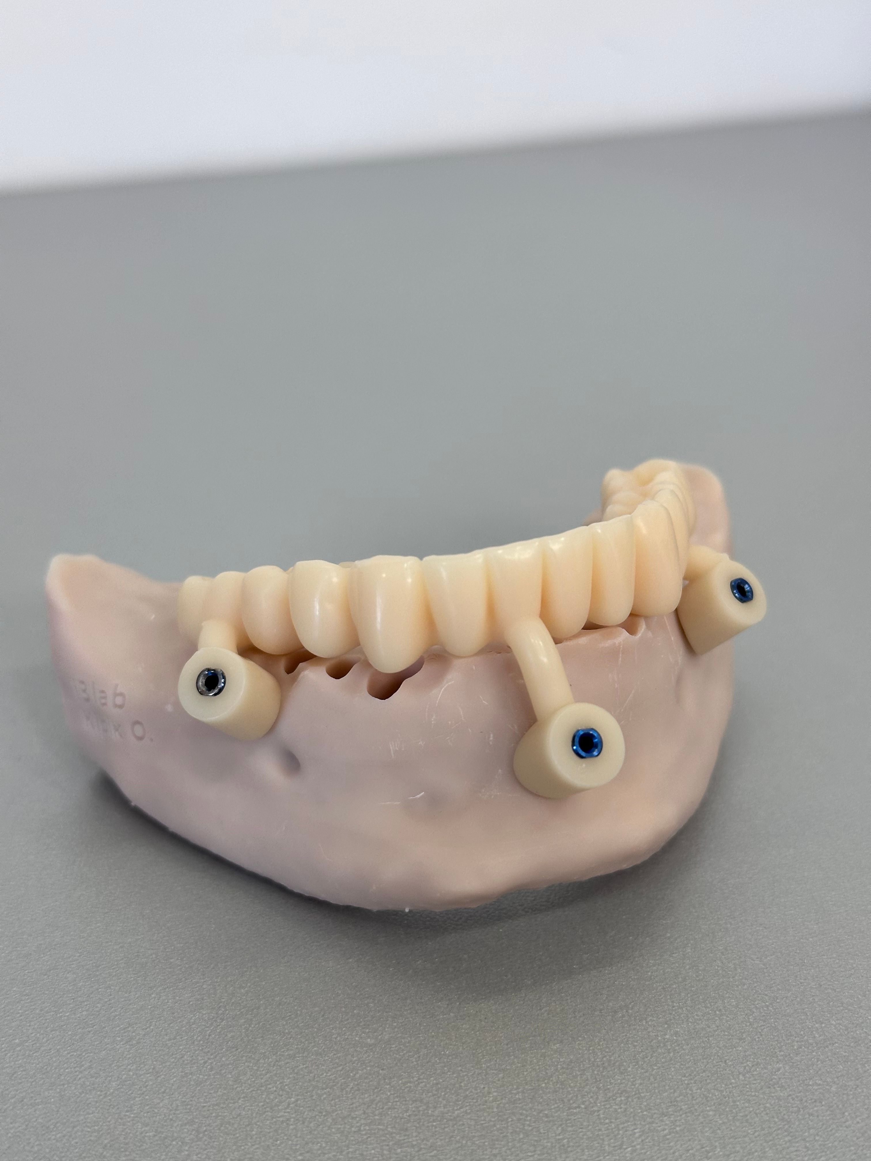 Modelo de prótesis dental mostrando implantes