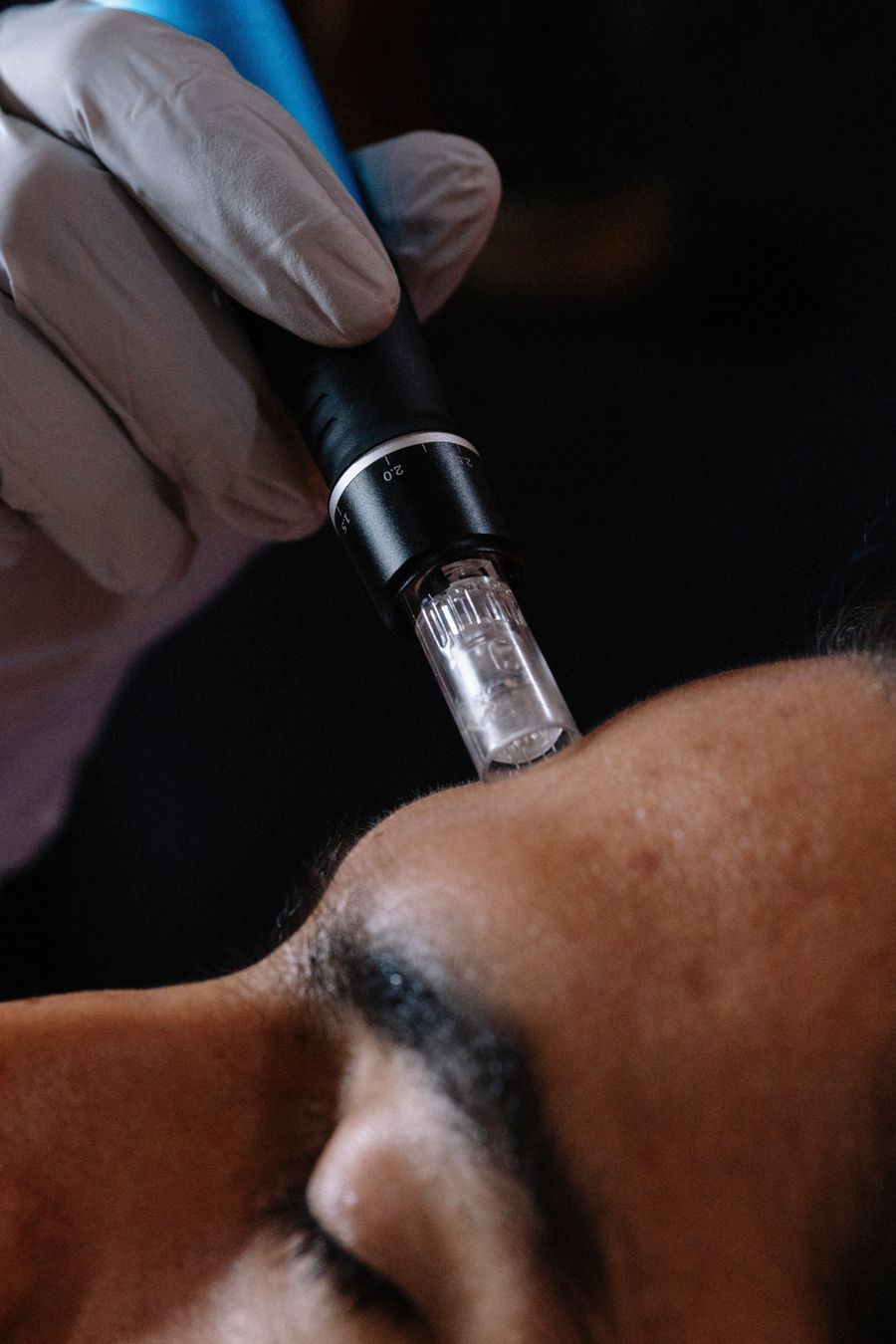 Close-up of a microneedling pen on the forehead