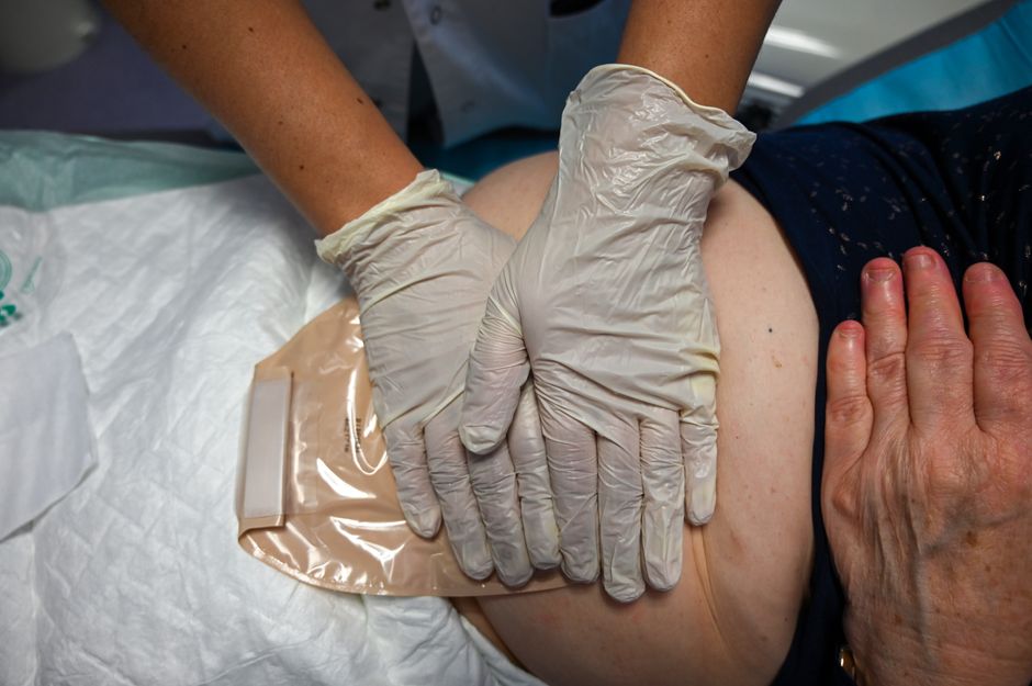 Nurse wearing gloves changes an ostomy pouch on a patient in a medical setting.