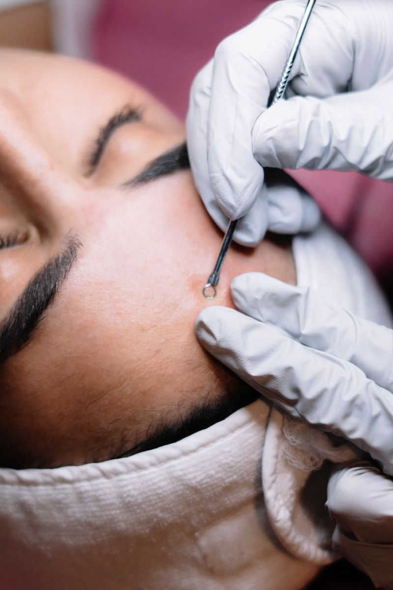 Deep Cleansing Akne-Behandlung Gesicht