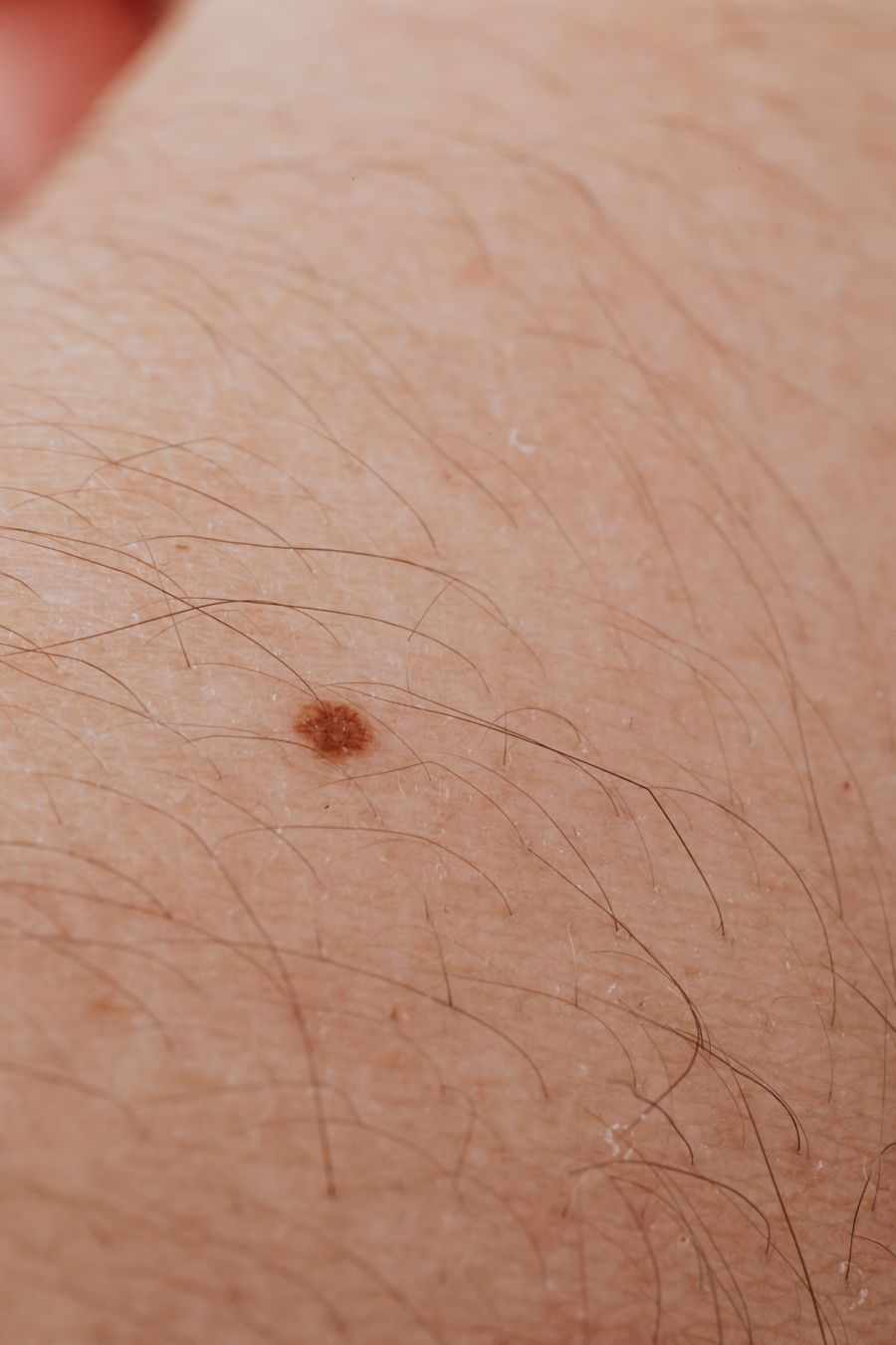 Close-up of a raised benign mole on the skin