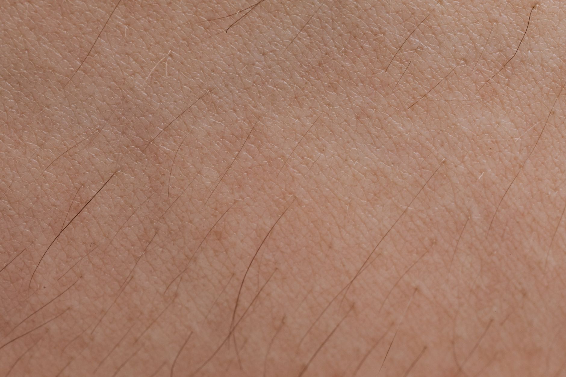 Ichthyosis Vulgaris: Understanding the 'Fish Scale Disease'