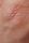 skin disease