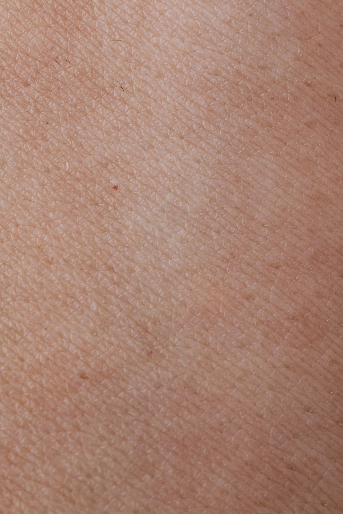 Acne adulta: por que aparece e o que realmente funciona