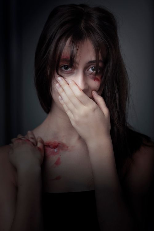 Woman With Bruise on Her Body