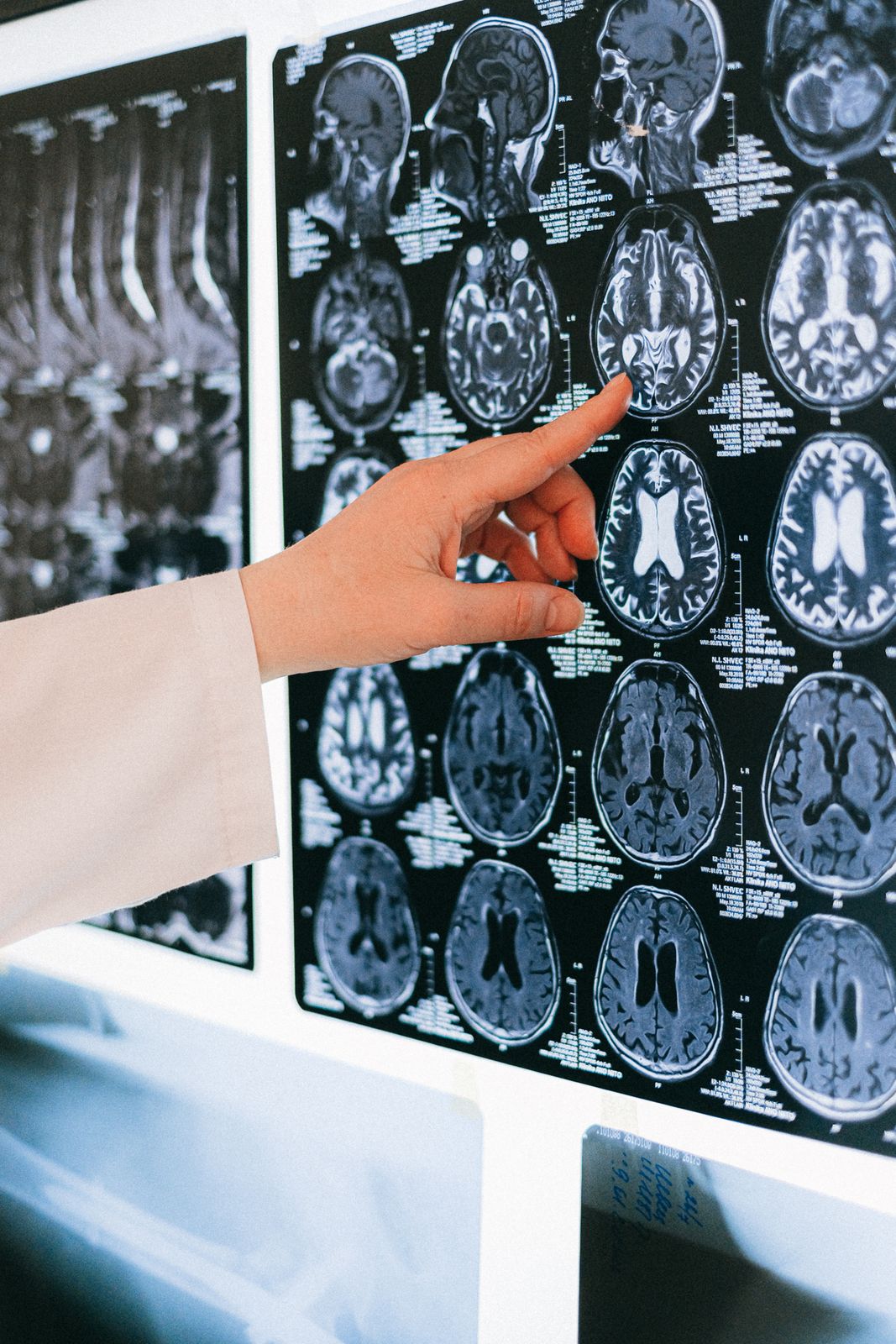 Lecanemab: We Finally Know How It Actually Works