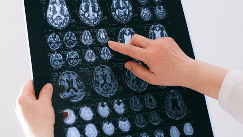 A medical professional examines a brain MRI scan, focusing on neurological health.