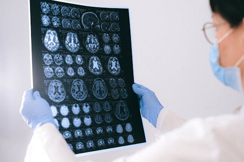 Fotos de stock gratuitas de alzheimer, cerebro, de cerca