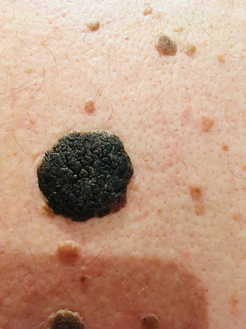 Fotos de stock gratuitas de condición de piel, mole en la espalda, topo
