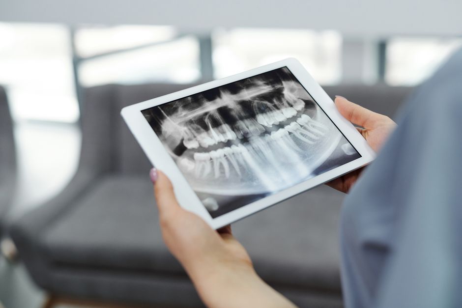 Dental X-ray showing third molars crowded at the back of the jawbone Dental X-ray showing third molars crowded at the back of the jawbone