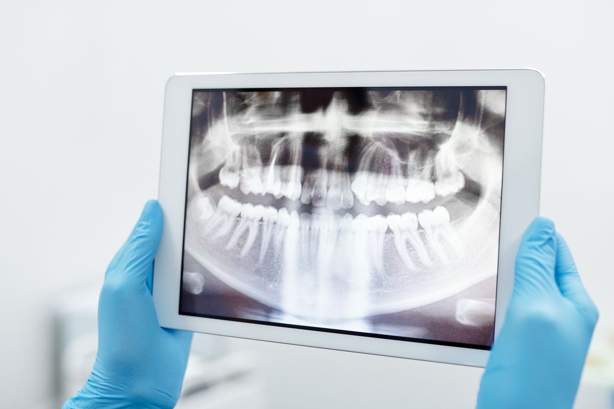 Dental team reviewing a digital tooth X-ray on a tablet before fiber post placement